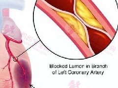 心肌缺血的原因心肌缺血是什么原因造成的？