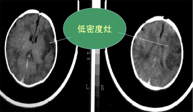 新生儿缺氧血性脑病有哪些症状，应该怎么治疗（嗜睡等）