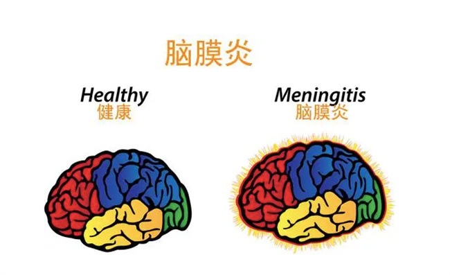 小儿患脑膜炎都有哪些症状（呕吐，头痛，腹泻等）