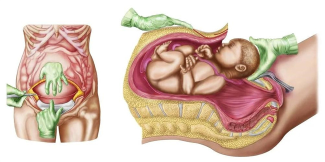 剖腹产和顺产的宝宝最大的区别是这三点