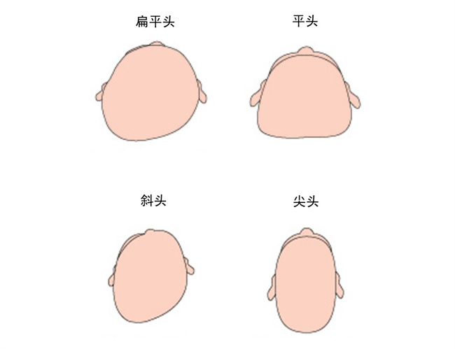 应该怎样预防宝宝睡偏头