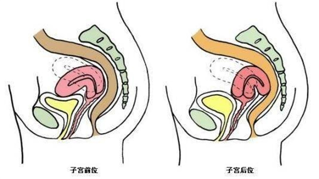 子宫后位是否会影响怀孕（会）