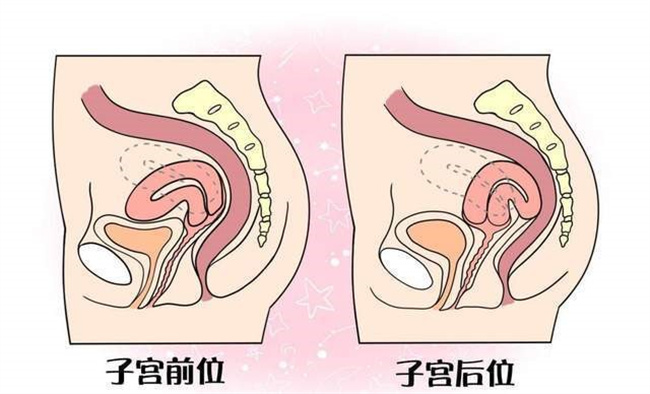 子宫后位是否会影响怀孕（会）