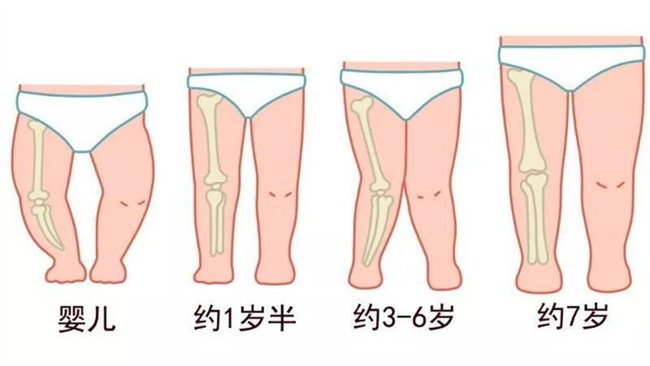 宝宝O型腿和X型腿是怎么形成的，应该怎样预防（与发育有关）