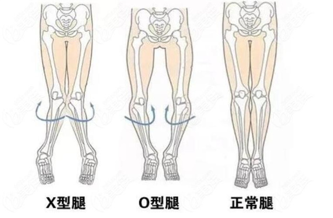 宝宝O型腿和X型腿是怎么形成的，应该怎样预防（与发育有关）