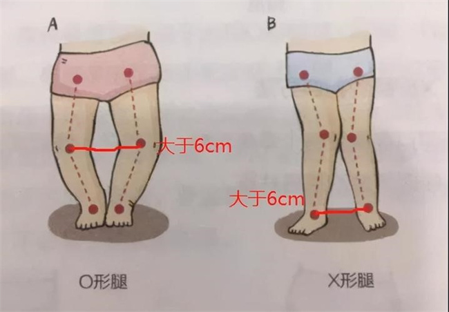 宝宝O型腿和X型腿是怎么形成的，应该怎样预防（与发育有关）