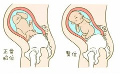 医生所说的宝宝臀位是什么意思（臀部朝下，头部朝上的异常胎位）