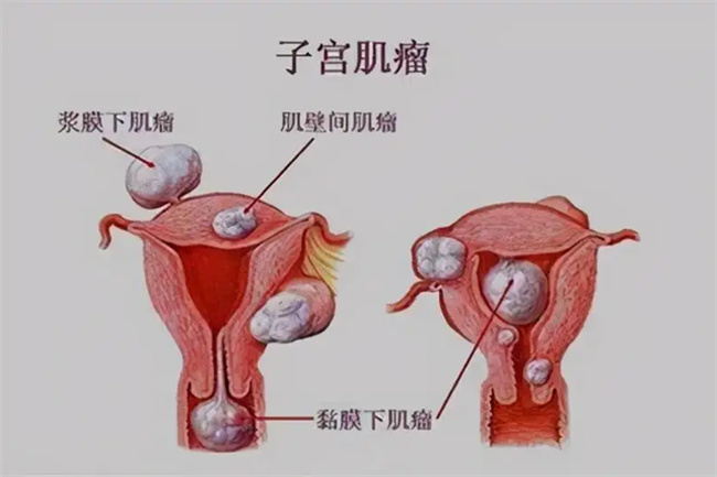 子宫肌瘤的危害有哪些（贫血、妇科感染、不孕等）