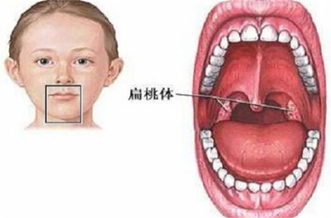 怎样防治小儿急性扁桃体炎（增强体质，预防感染）