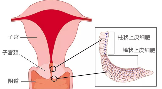 什么是宫颈柱状上皮异位