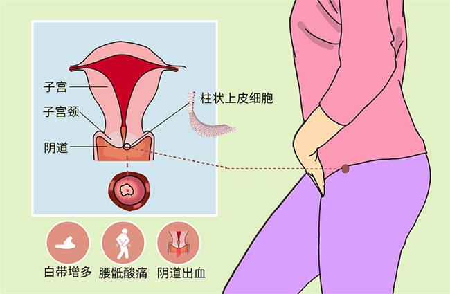 什么是宫颈柱状上皮异位