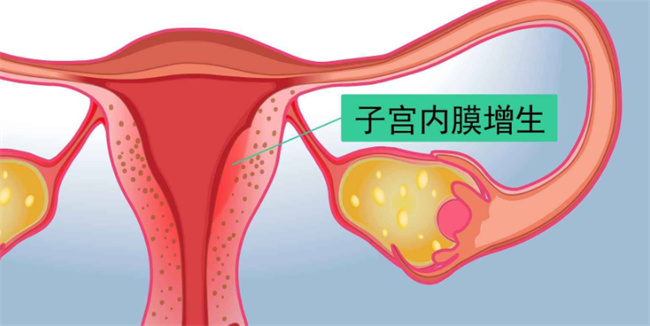 什么是子宫内膜增生