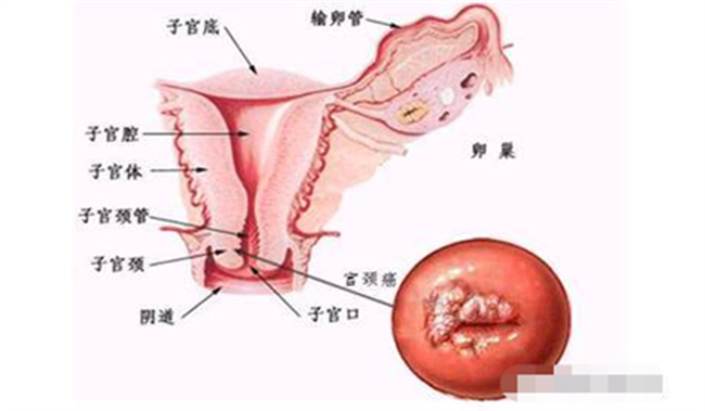 宫颈肥大是怎么引起的