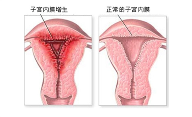 什么是子宫内膜增生