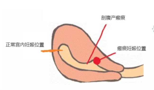 瘢痕子宫是否可以怀孕