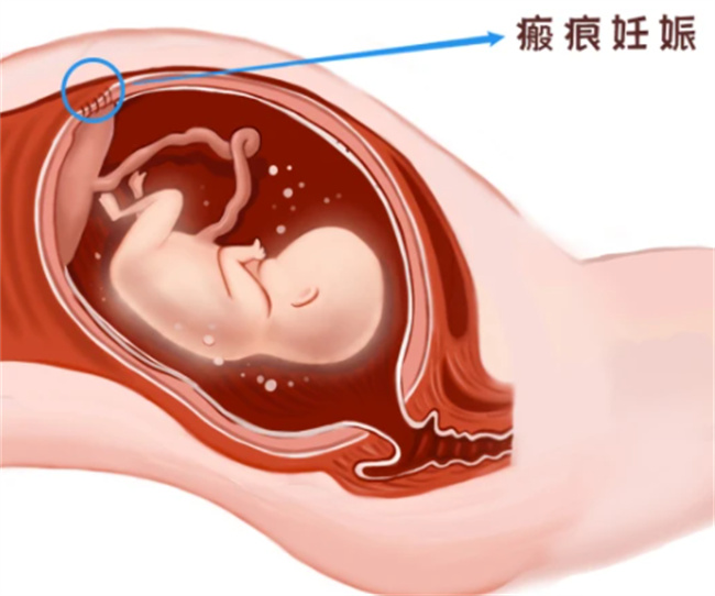 瘢痕子宫是否可以怀孕