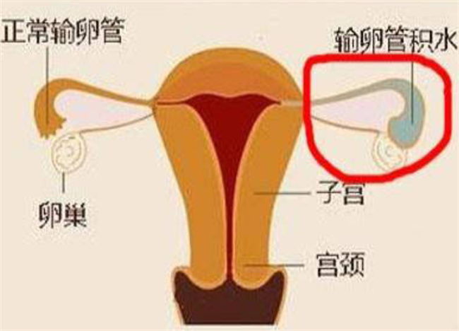 宫腔积脓是怎么形成的