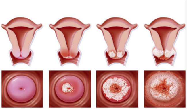 轻度宫颈糜烂的治疗方法