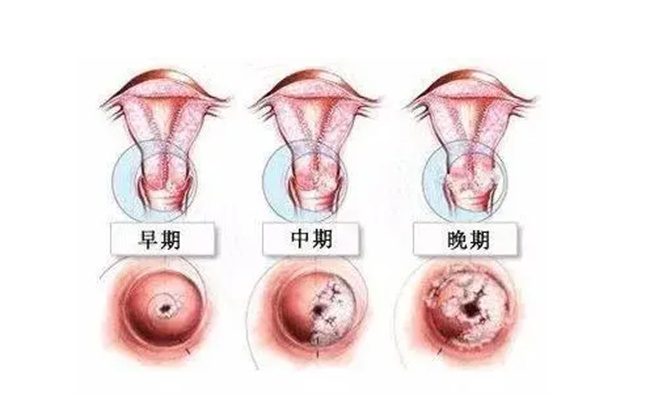 轻度宫颈糜烂的治疗方法