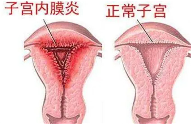 慢性子宫内膜炎能治愈吗