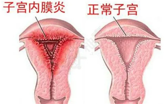 子宫内膜炎是否会发生癌变