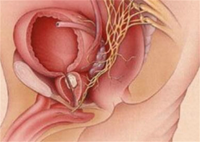 前庭大腺癌可以治愈吗