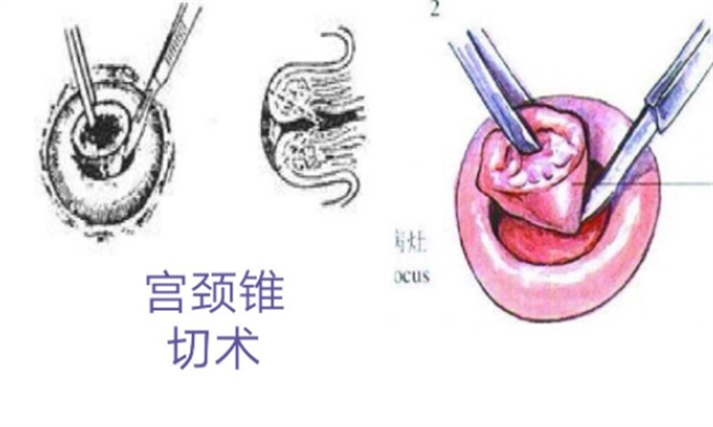 宫颈锥切术后有哪些注意事项