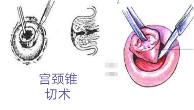 宫颈锥切后容易癌变吗 应该如何护理