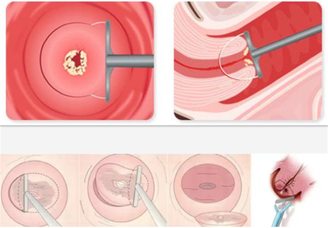 宫颈锥切后容易癌变吗 应该如何护理
