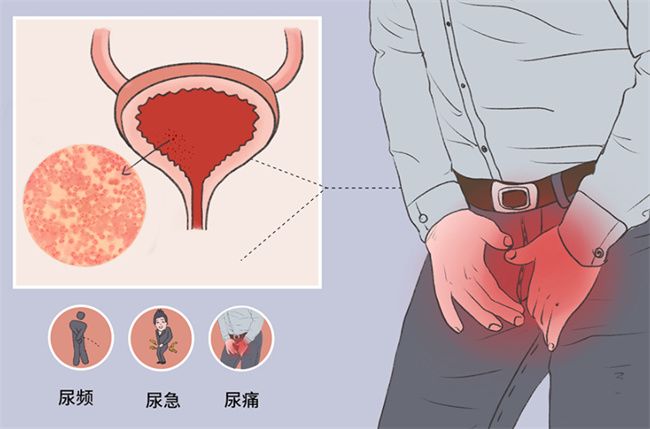 蛲虫性尿道炎有哪些症状