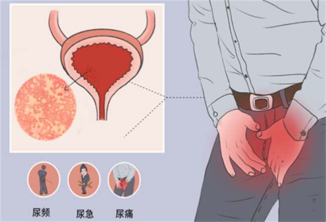 急性尿道炎的治疗方法