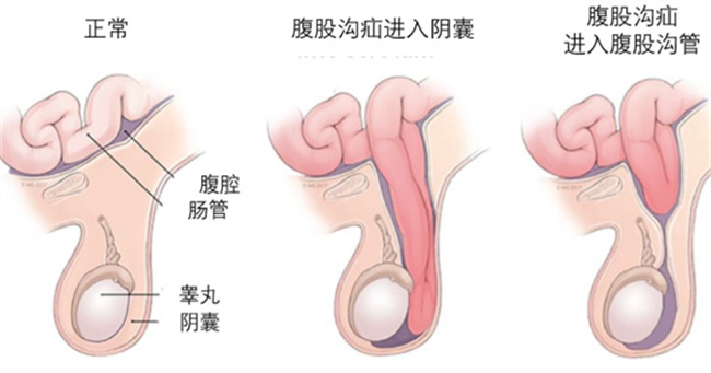 腹股沟疝气的症状有哪些