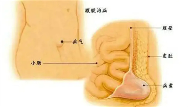 腹股沟疝气的症状有哪些