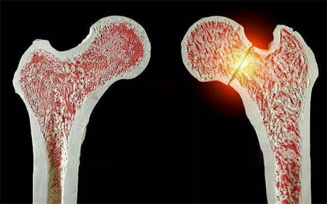 骨头坏死的具体原因有哪些