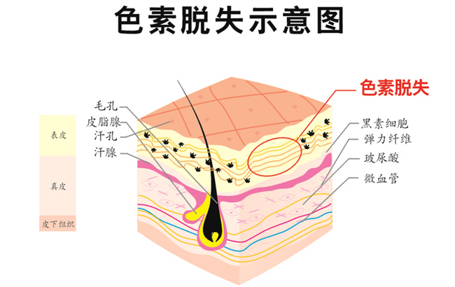 白斑病的初期表现有哪些