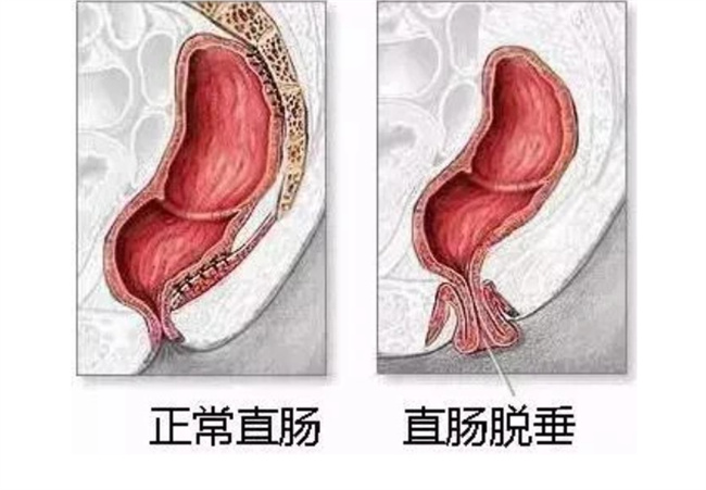 尿道口粘膜脱垂的原因