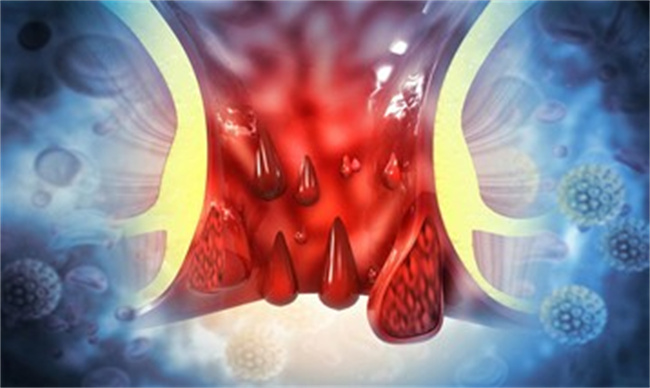 内痔便血是怎样引起的