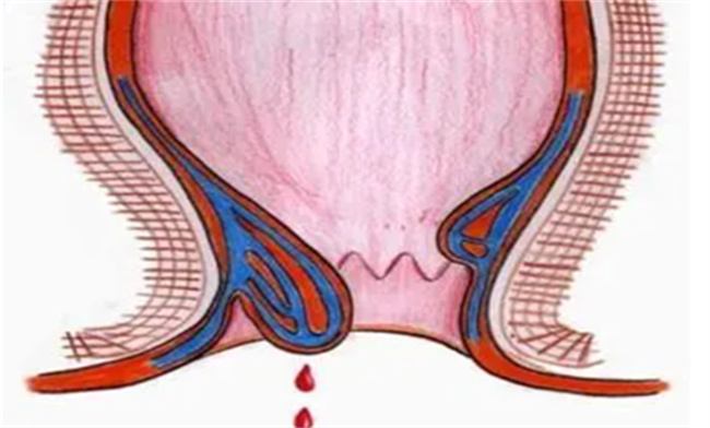 内痔便血是怎样引起的