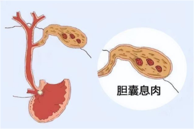 胆囊息肉的危害有哪些