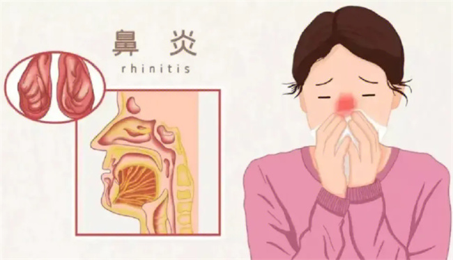 鼻炎发病的原因