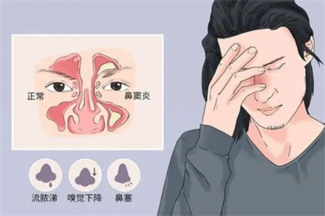 鼻炎发病的原因