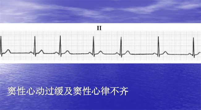 窦性心动过缓严重吗