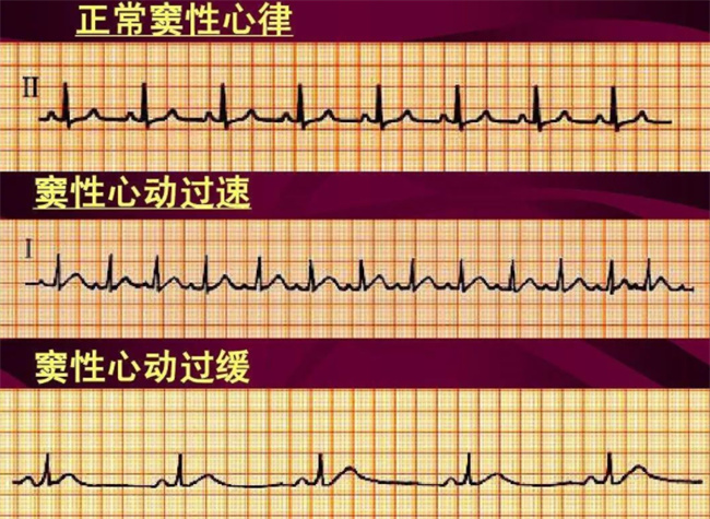 窦性心动过缓严重吗