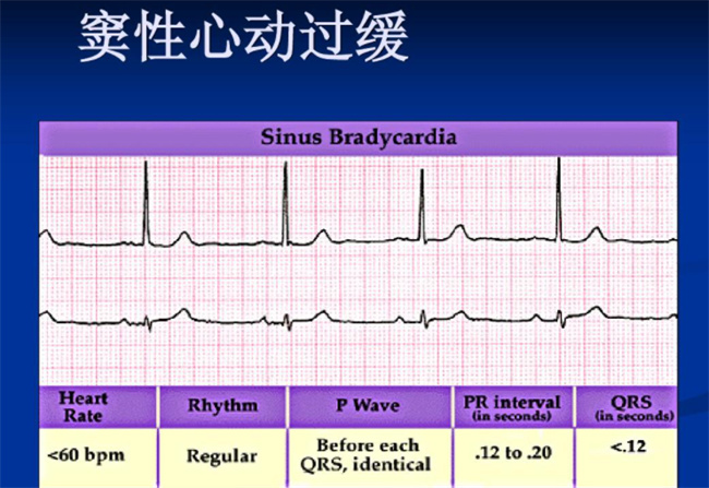 窦性心动过缓严重吗