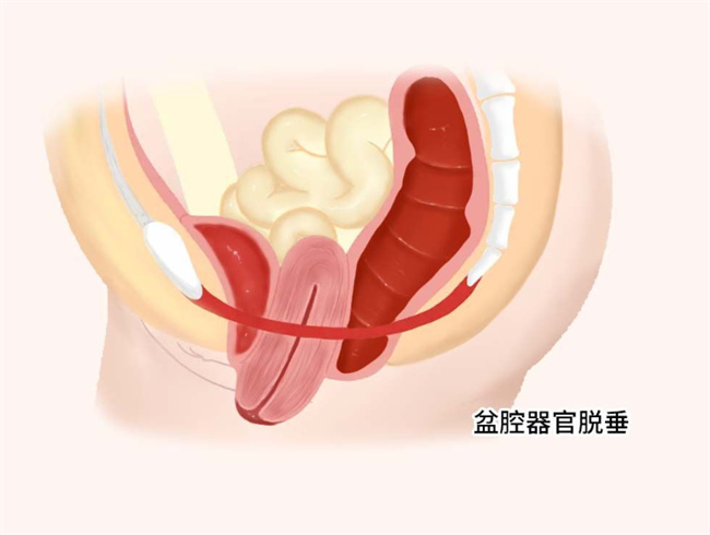 盆腔脏器脱垂是什么意思 有什么症状