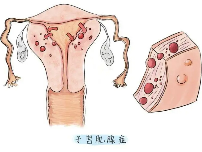 解析子宫腺肌症：治疗方法与疗效展望