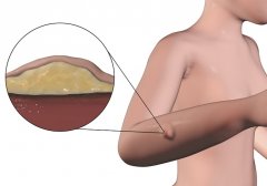 脂肪瘤治疗方法解析：手术切除与中药治疗