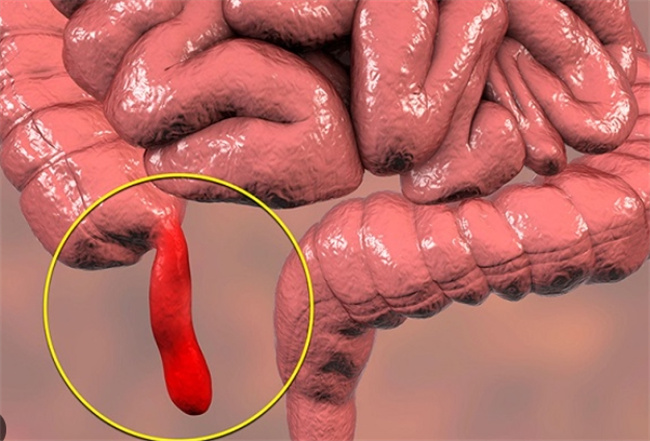 预防阑尾炎：了解原因，改善生活习惯