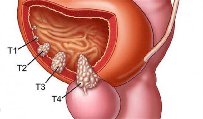 前列腺癌患者的生命时长和饮食调养