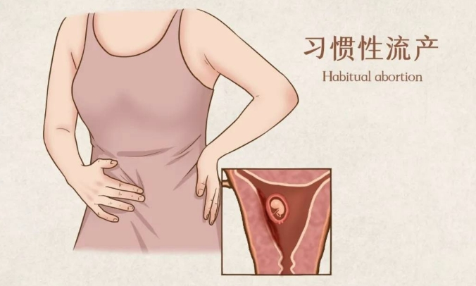 习惯性流产：症状、原因与预防